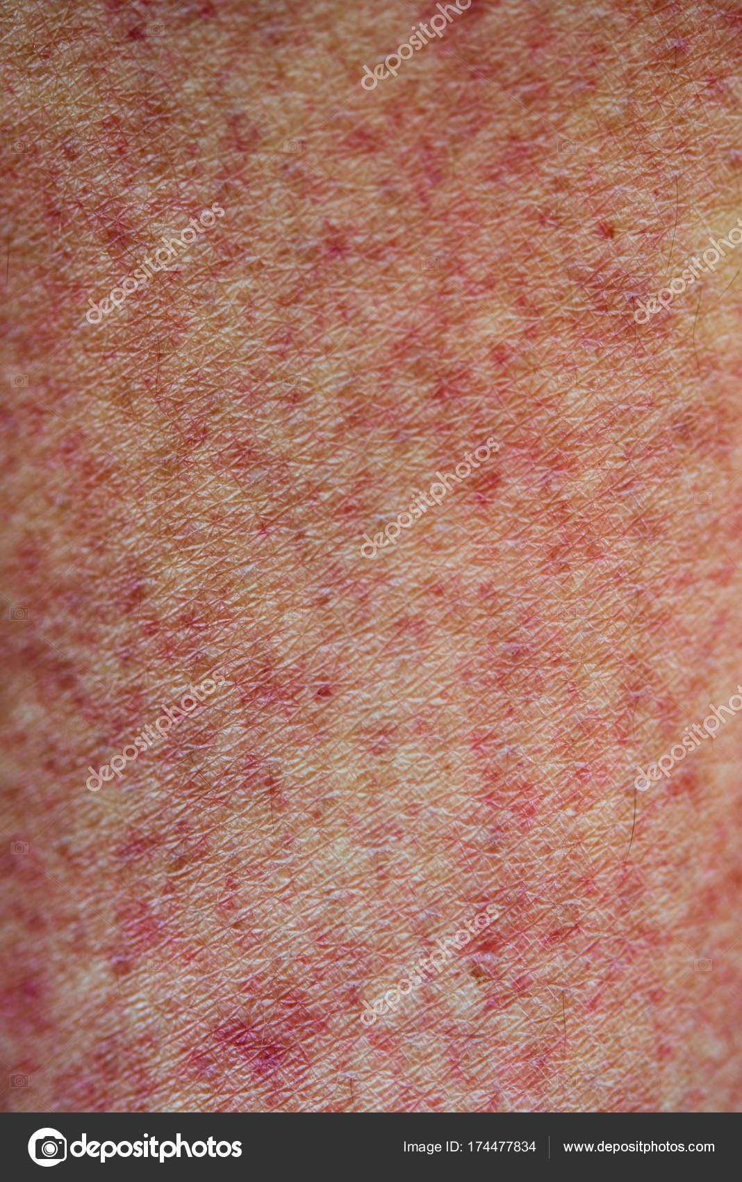 Skin With Red Rashes — Stock Photo © Szefei 174477834