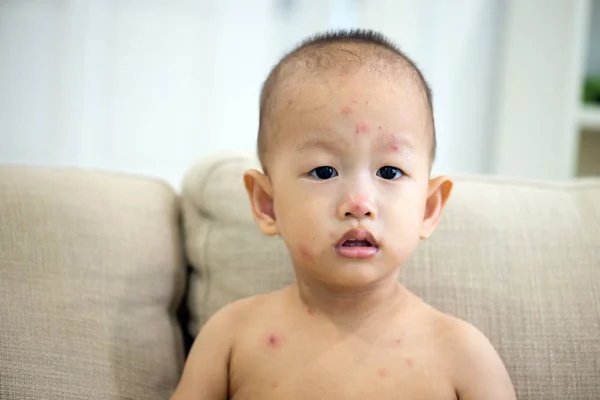 Bambino con varicella sul divano — Foto Stock