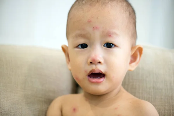 Asiático bebé niño con la varicela —  Fotos de Stock