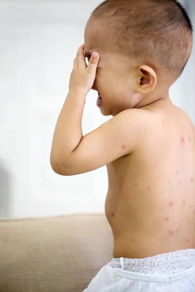 Niño con varicela llorando —  Fotos de Stock