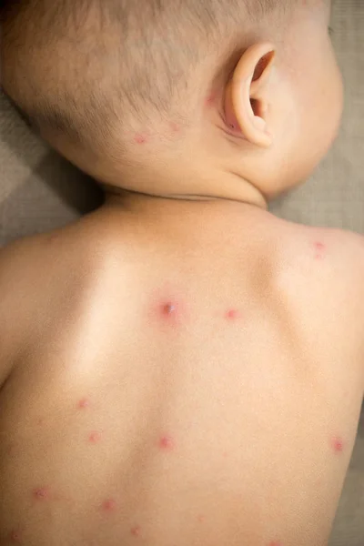 Bebé de vuelta con varicela —  Fotos de Stock