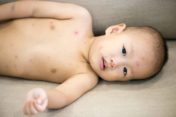 Bambino con varicella sdraiato sul divano — Foto Stock