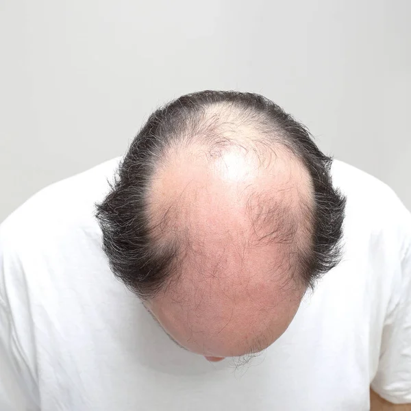 Bald Middle Age Man — Stock Photo, Image