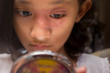 Yüzünde ve burnunda dairesel deri döküntüleri olan Güneydoğu Asya kökenli genç kız aynaya bakıyor. Tinea Corporis dermatit sorunu