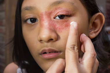 Yüzünde göz ve burun çevresinde dairesel deri döküntüsü olan Güneydoğu Asya kökenli genç kız ilaç tedavisi için mantar kremi uygulanıyor. Tinea Corporis dermatit sorunu