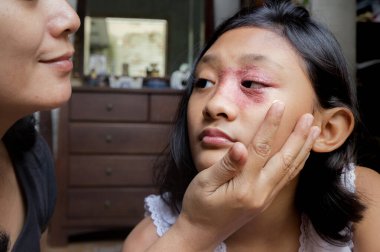 Yüzünde dairesel deri döküntüsü olan Güneydoğu Asya kökenli genç kız, annesi tarafından tedavi için mantar kremi uygulanıyor. Tinea Corporis dermatit sorunu