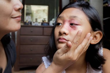 Southeast Asian ethnicity teenage girl with circular shape skin rash on her face, being applied Antifungal cream for medication by her mother. Tinea Corporis dermatitis skin problem clipart