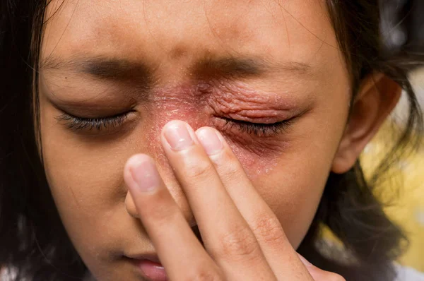 동남아시아의 소녀는 가려운 주위의 얼굴에 생기는 피부염때문에 괴로워했다 — 스톡 사진