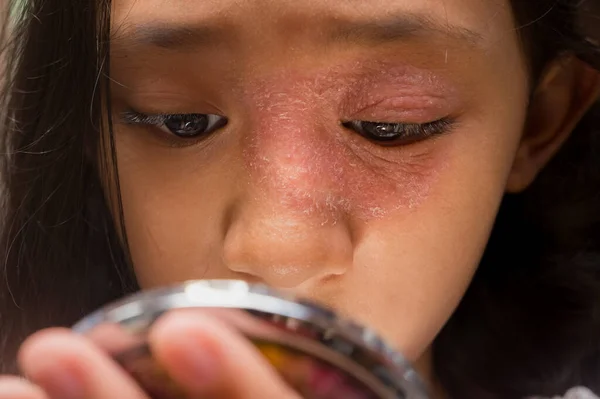 Südostasiatisches Teenagermädchen Mit Kreisförmigem Hautausschlag Gesicht Augen Und Nase Das — Stockfoto