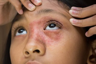 Yüzünde ve burnunda dairesel deri döküntüsü olan Güneydoğu Asya kökenli genç kız Tinea Corporis dermatit sorunu var.