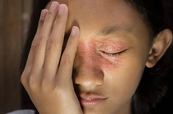 Yüzünde ve burnunda kızarıklık olan yuvarlak şekilli Güneydoğu Asya kökenli genç kız Tinea Corporis dermatit sorunu var.