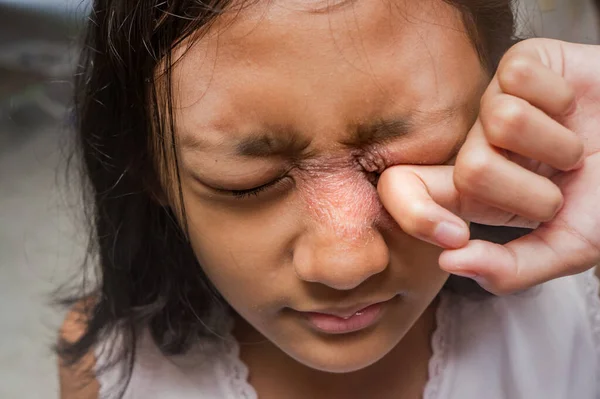 Sudeste Asiático Etnia Adolescente Menina Irritada Com Coceira Doença Pele — Fotografia de Stock