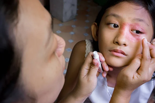 Southeast Asian ethnicity teenage girl with circular shape skin rash on her face around the eye and nose, being applied Anti fungal cream for medication by her mother. Tinea corporis dermatitis skin problem