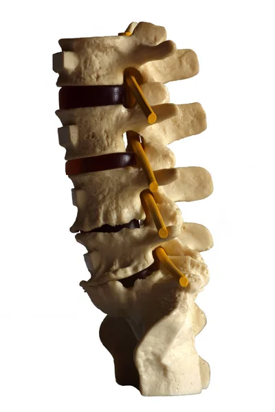 Spine Disc Degenerated Osteophyte Formation — Stock Photo, Image