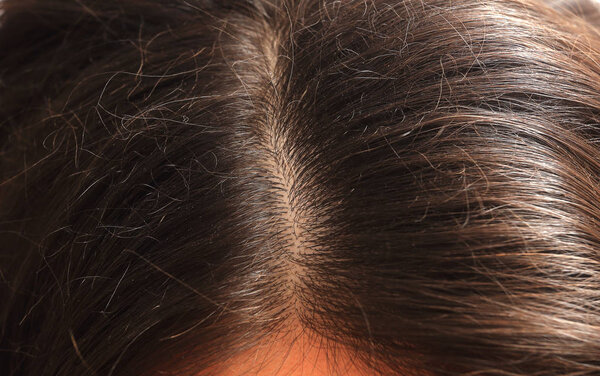 Brown hair with dandruff.