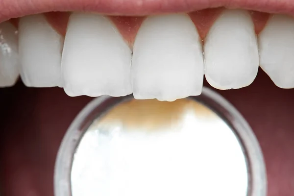 Primo piano dei denti anteriori umani — Foto Stock