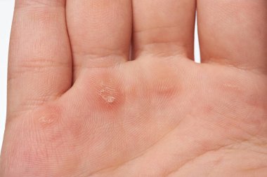 Blister insan eli üzerinde makro