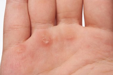 Macro of blister on human hand clipart