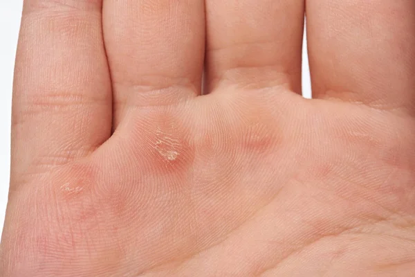 Macro of blister on human hand — Stock Photo, Image