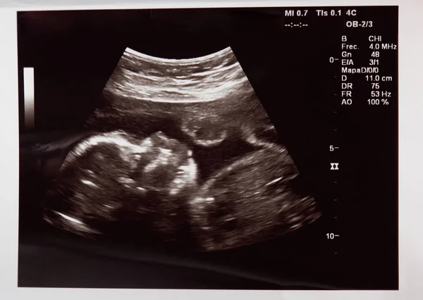 Baby head on ultrasound scan