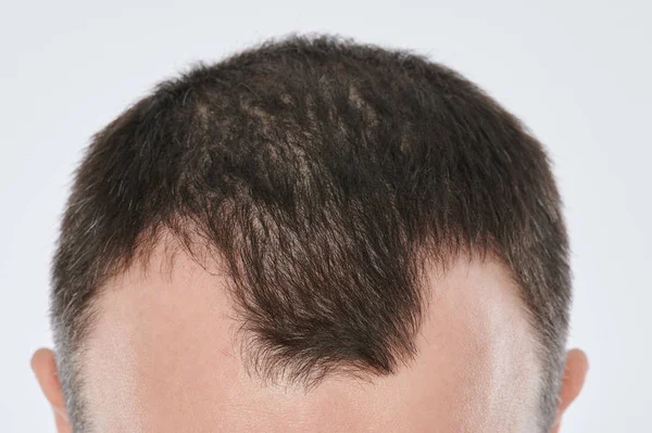 Поврежденные волосы — стоковое фото
