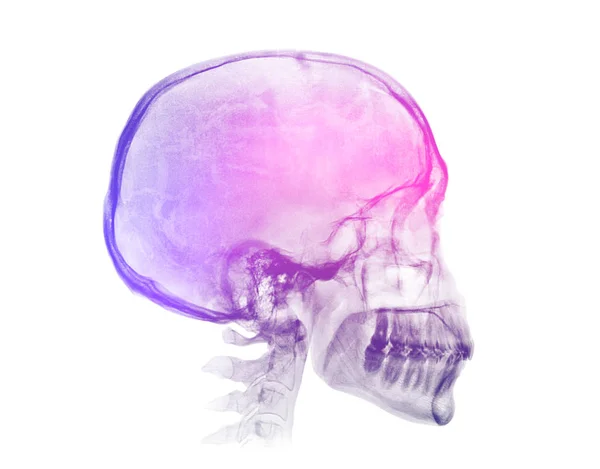 Imagem radiológica do crânio humano — Fotografia de Stock