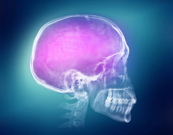 Рентгенівське зображення людського черепа — стокове фото