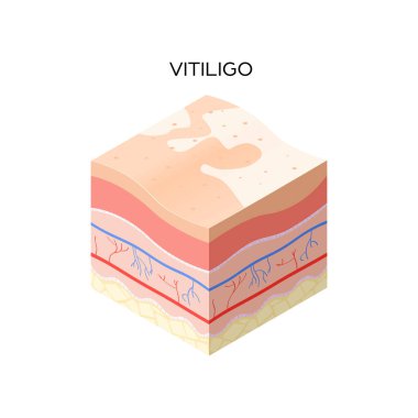 İnsan derisinin vitiligo deri kesitleri. Cilt yapısı. Tıbbi konsept düz.