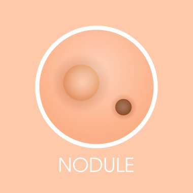 Deri nodülü sivilceler sivilce tipi sivilceler gözenekli boşluklar kozmetoloji cilt sorunları kavramı düz