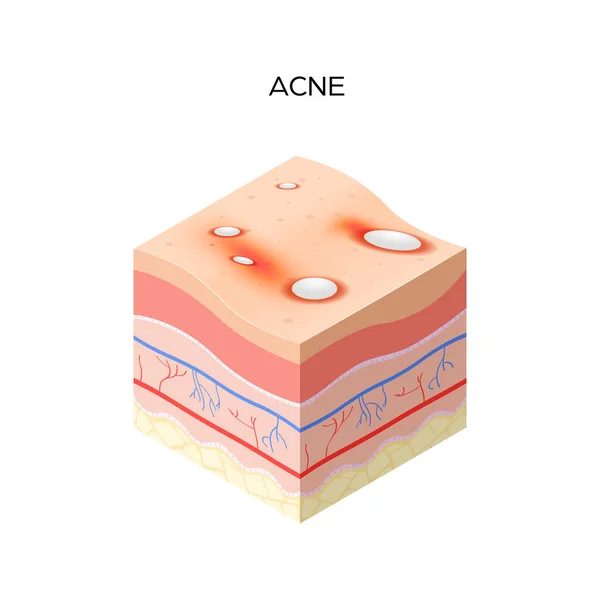 Acné vulgaris ou bouton coupe transversale des couches de peau humaine structure soins de la peau concept médical plat — Image vectorielle