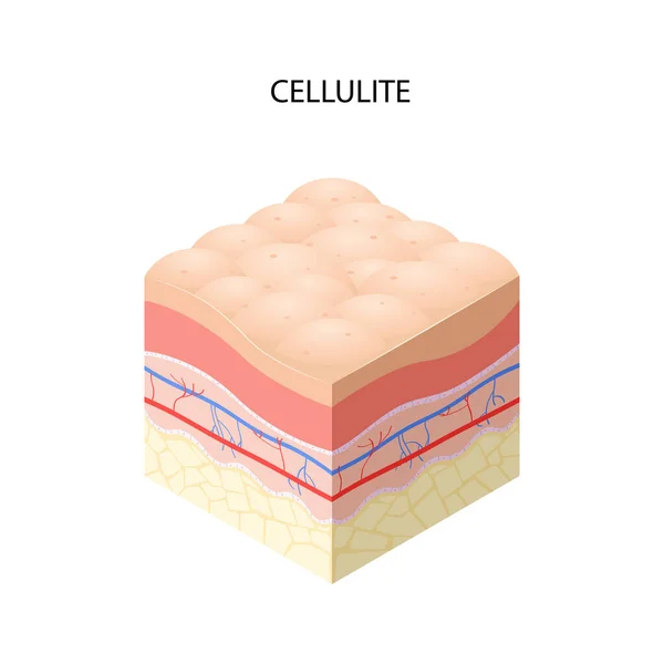 Pele com celulite seção transversal de camadas de pele humana estrutura cuidados com a pele conceito médico plana —  Vetores de Stock