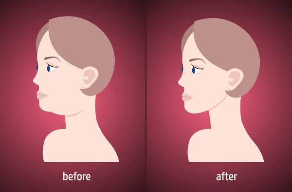 Cara de mujer antes y después de doble barbilla corrección de grasa procedimiento medicina estética concepto retrato horizontal — Archivo Imágenes Vectoriales