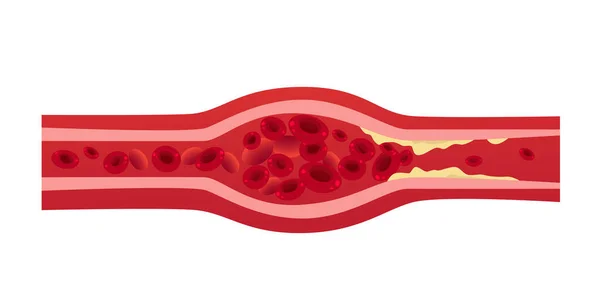 Obstrucción de la arteria de los vasos sanguíneos con células de acumulación de colesterol creando obstrucción en la trombosis arterial concepto médico horizontal — Vector de stock