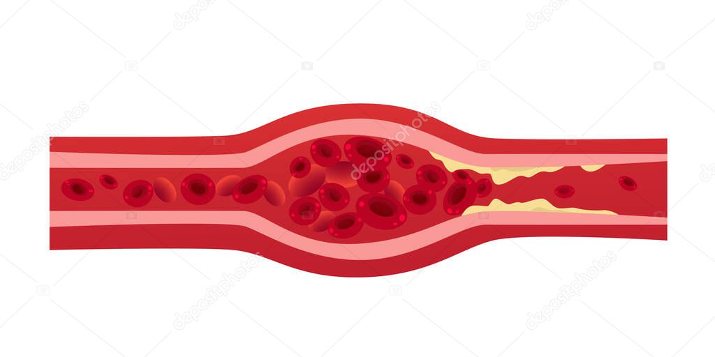 blocked blood vessel artery with cholesterol buildup cells creating blockage in artery thrombosis medical concept horizontal