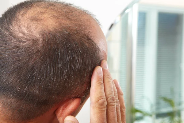 Homem sênior e perda de cabelo questão — Fotografia de Stock