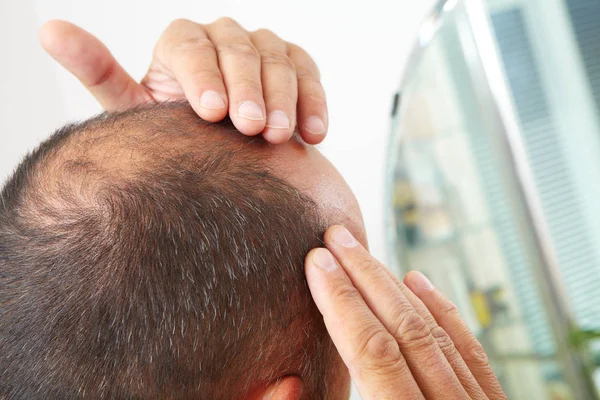 Uomo anziano e perdita di capelli problema — Foto Stock