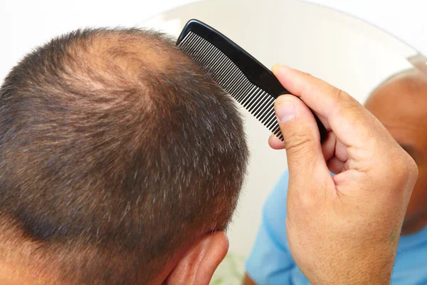Hombre mayor y problema de pérdida de cabello — Foto de Stock