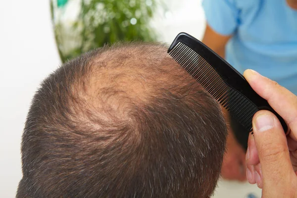 Senior man and hair loss issue — Stock Photo, Image