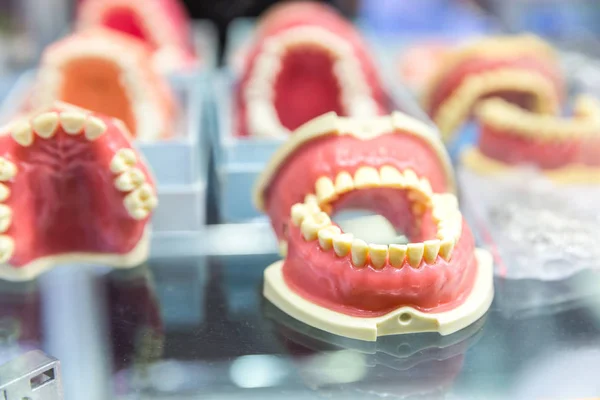 Σαγόνια οδοντικά εμφυτεύματα — Φωτογραφία Αρχείου