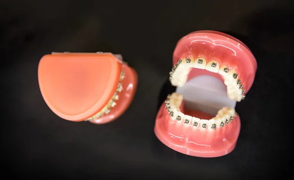 Implantes dentales en la clínica —  Fotos de Stock