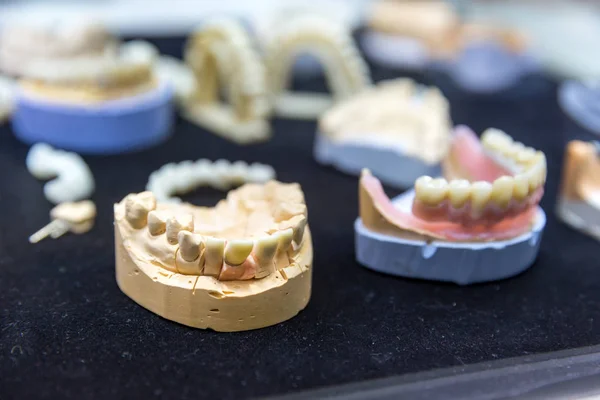 Implantes dentários na clínica — Fotografia de Stock