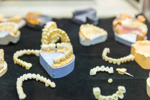 Зубні імплантати в клініці — стокове фото