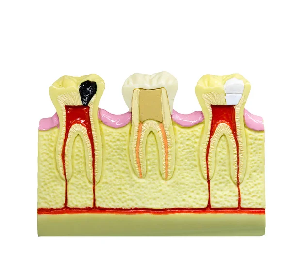 Dientes en maqueta de mandíbula —  Fotos de Stock