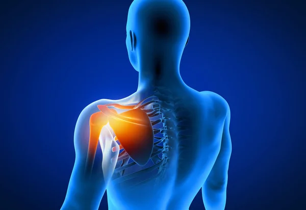 3d rendered illustration of a painful shoulder — Stock Photo, Image