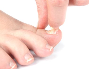 Erkek ayak ve ayak parmakları ile hasarlı çivi