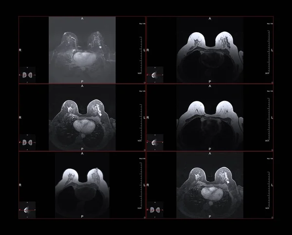 乳腺磁共振图像 Mri 在较大的图像明亮的白色点是第一阶段乳腺癌 — 图库照片