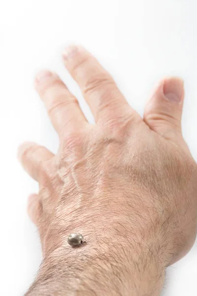 Tick sucked blood on human skin — Stock Photo, Image