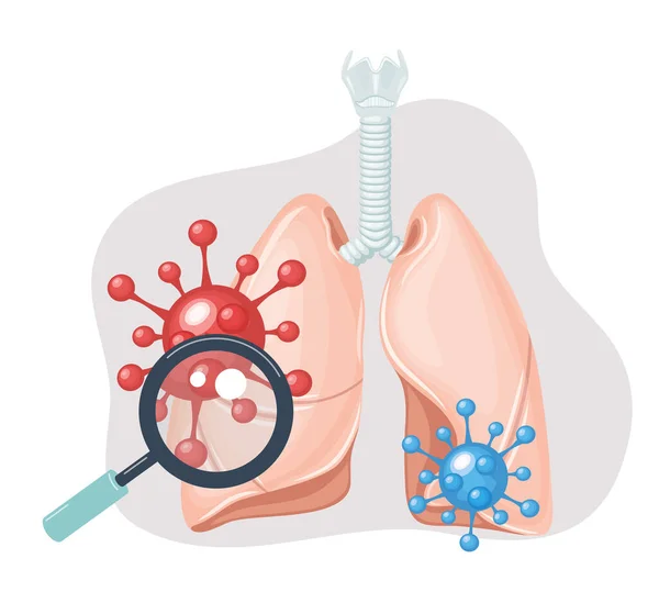 人类的肺沙士病，肺里有大肠病毒。Coronavirus — 图库矢量图片