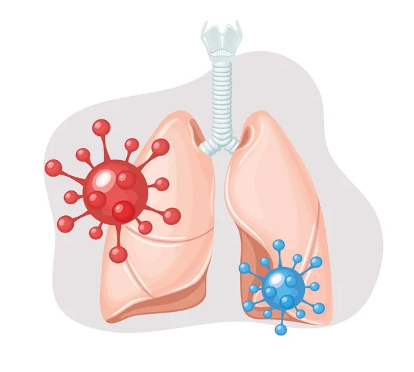 人类的肺沙士病，肺里有大肠病毒。Coronavirus — 图库矢量图片