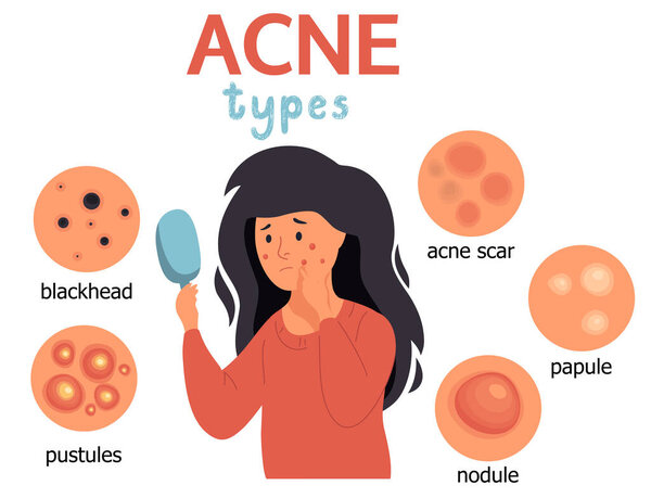 Acne infographic. Unhappy girl struggling with acne,pimples. Skin face irritation problem.